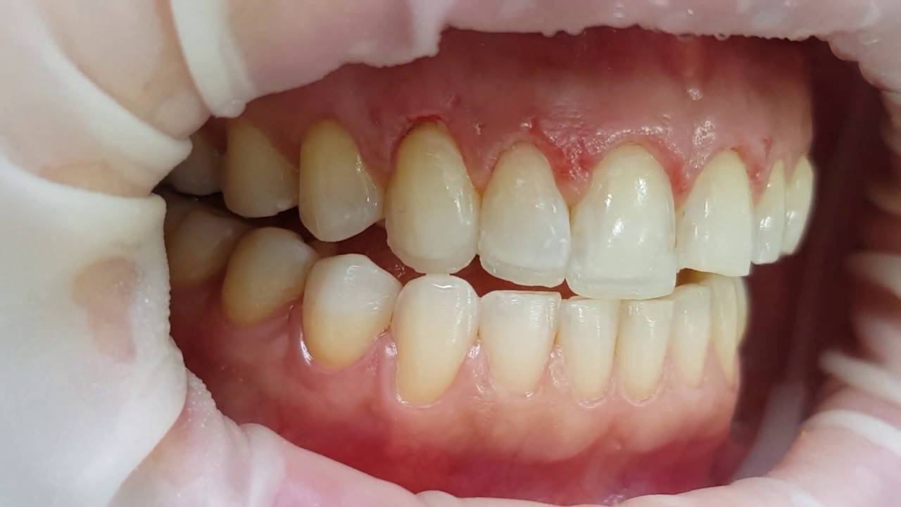 Ajuste oclusal - Amparo Aguirre Atenas Smile Experts