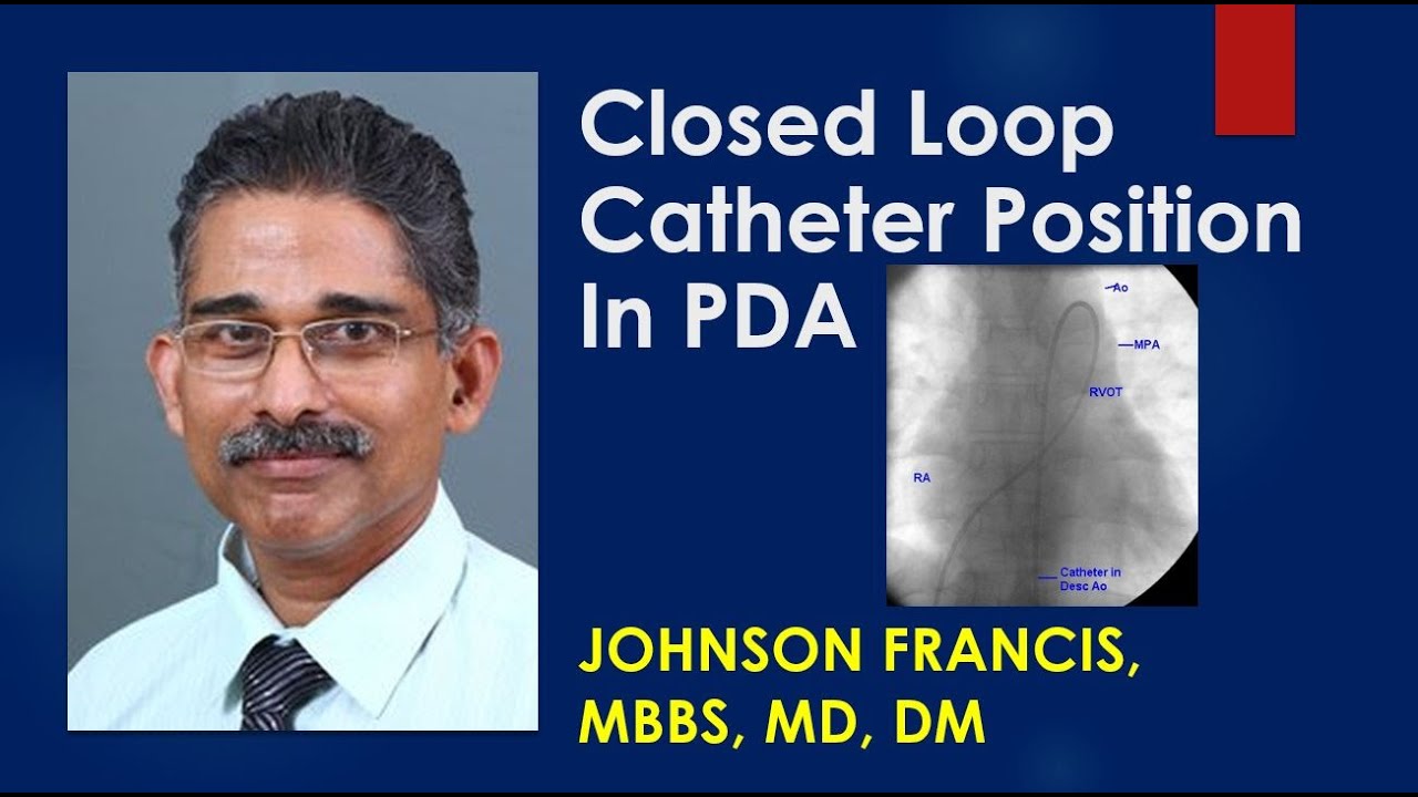 Closed Loop Catheter Position In Patent Ductus Arteriosus (PDA)