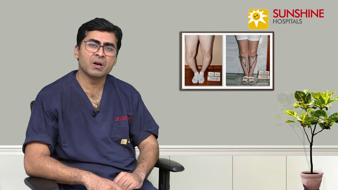 Watch Dr. Vidyasagar Chandankere, talk about Bow legs and Knock Knees in Childrens at Sunshine