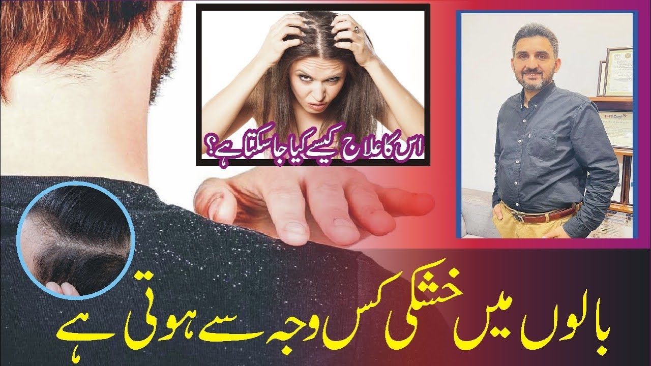 What’s dandruff / seborrhoea / seborrhic dermatitis / causes and treatment