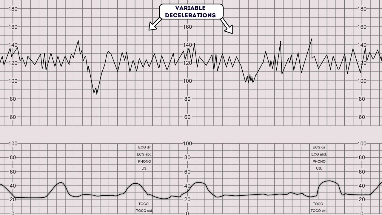 شرح CTG cardiotocography