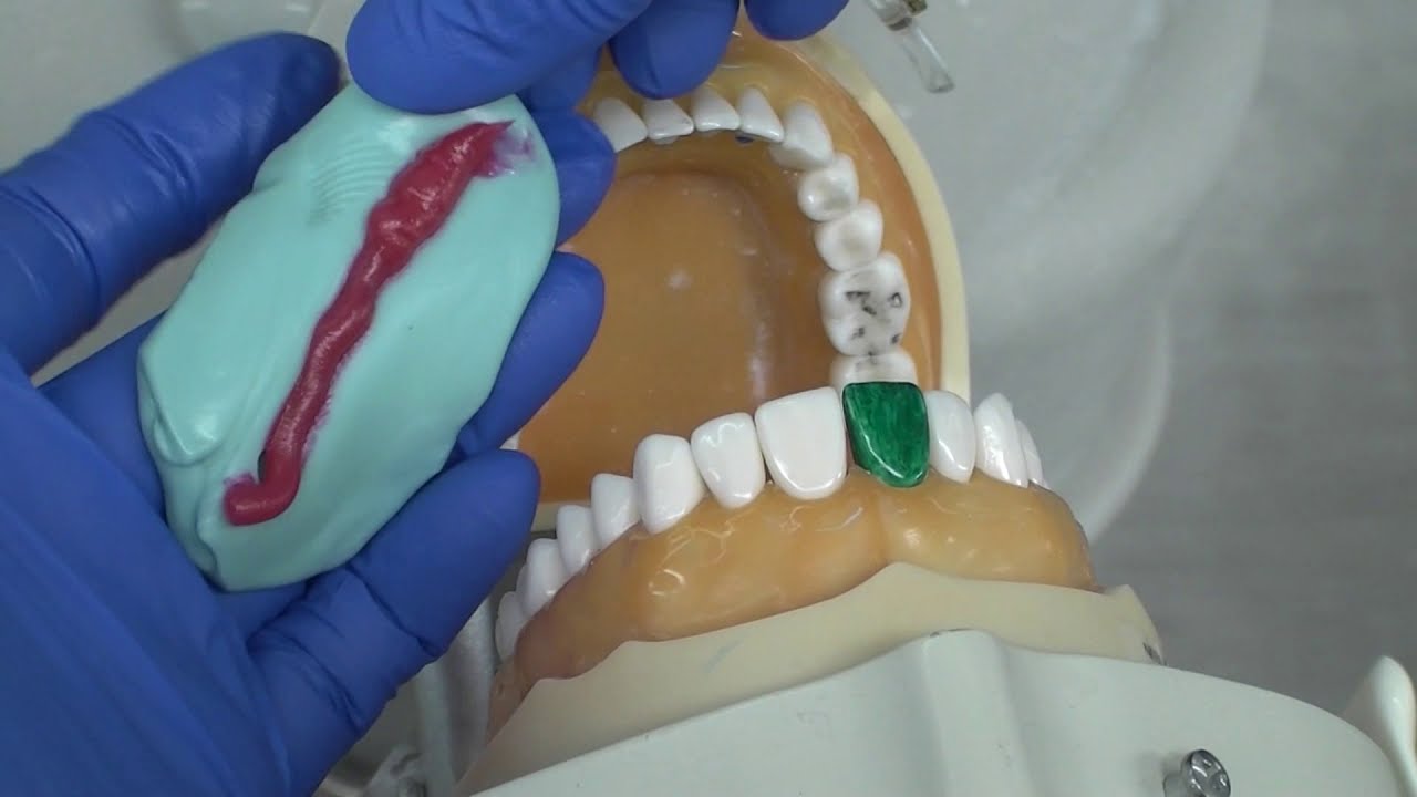 A method for temporary crown