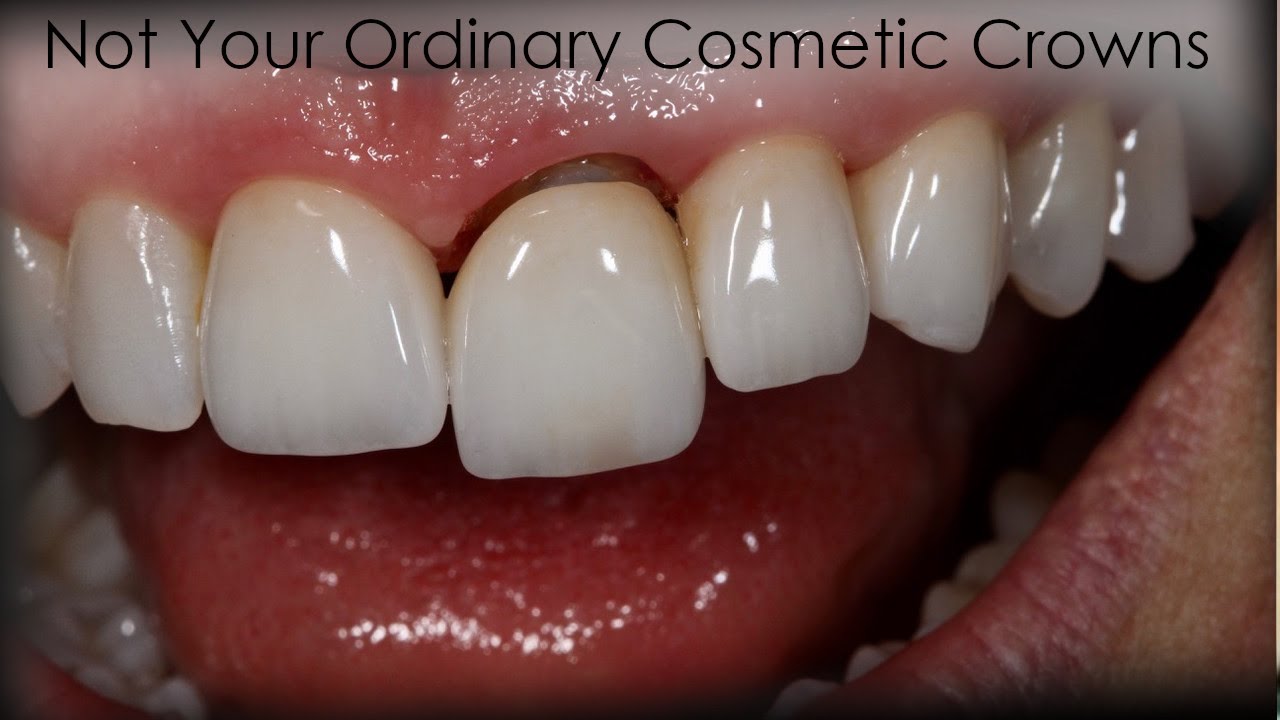 How To Make Extraordinary Cosmetic Crowns | Dental Lab & Patient Education