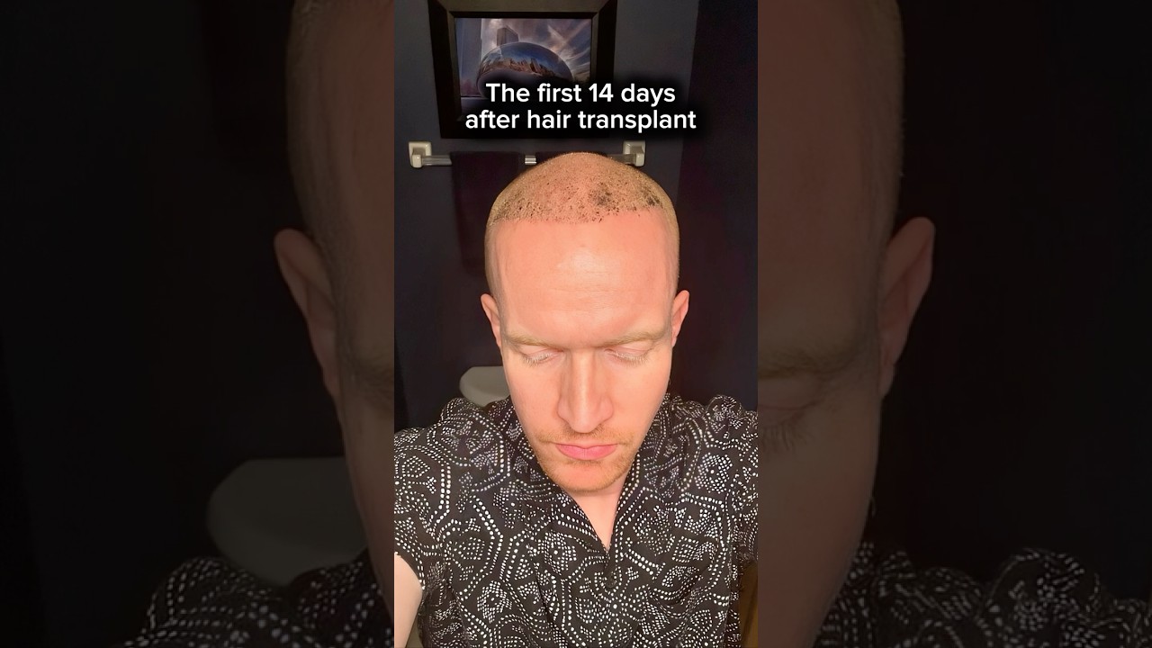Hair Transplant Results: What Happens in the First 14 Days? (Shocking!)