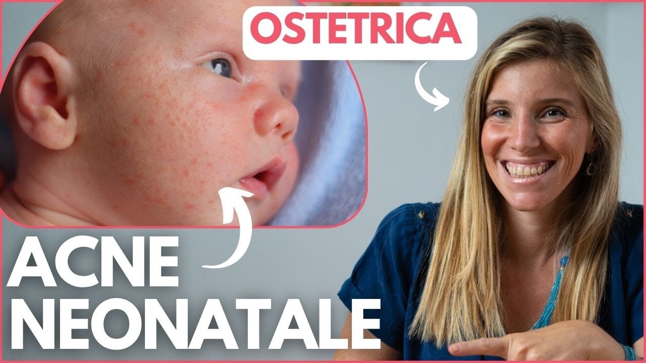 ACNE NEONATALE: Cos'è, le Cause, Quanto dura e Come Curarlo - L'Ostetrica risponde su Dr-Silva.com