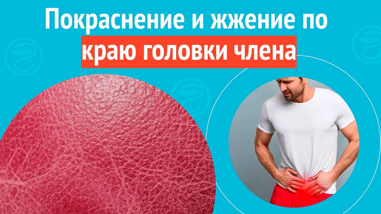 🥵 Покраснение и жжение по краю головки члена. Клинический случай № 1751