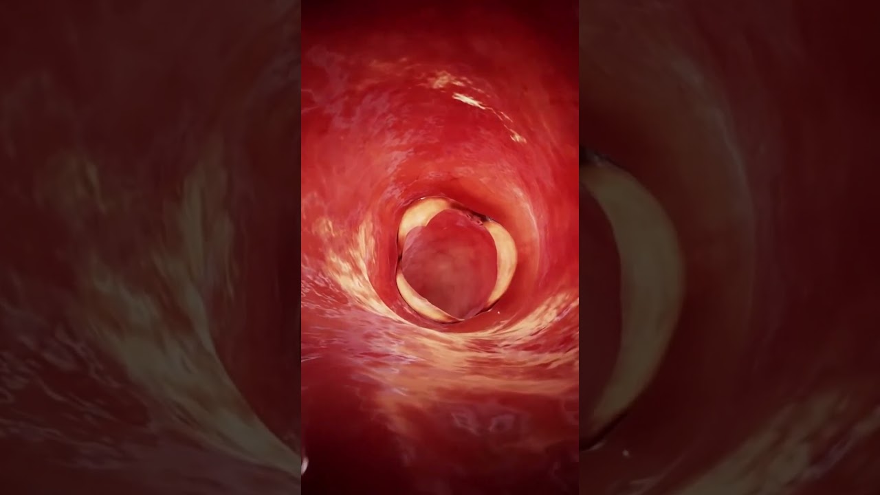 Journey through the Pulmonary Trunk