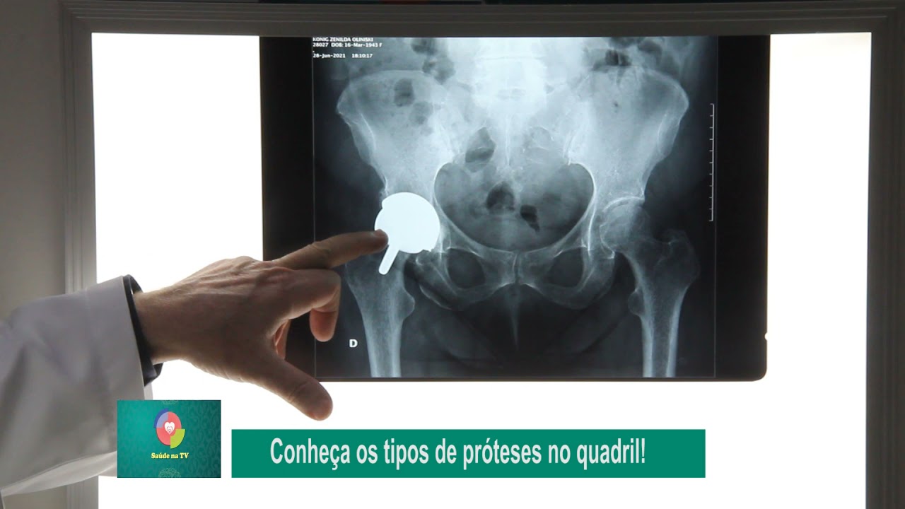 COMO VER UM RX DE PRÓTESE DE QUADRIL - protese de Resurface e outras