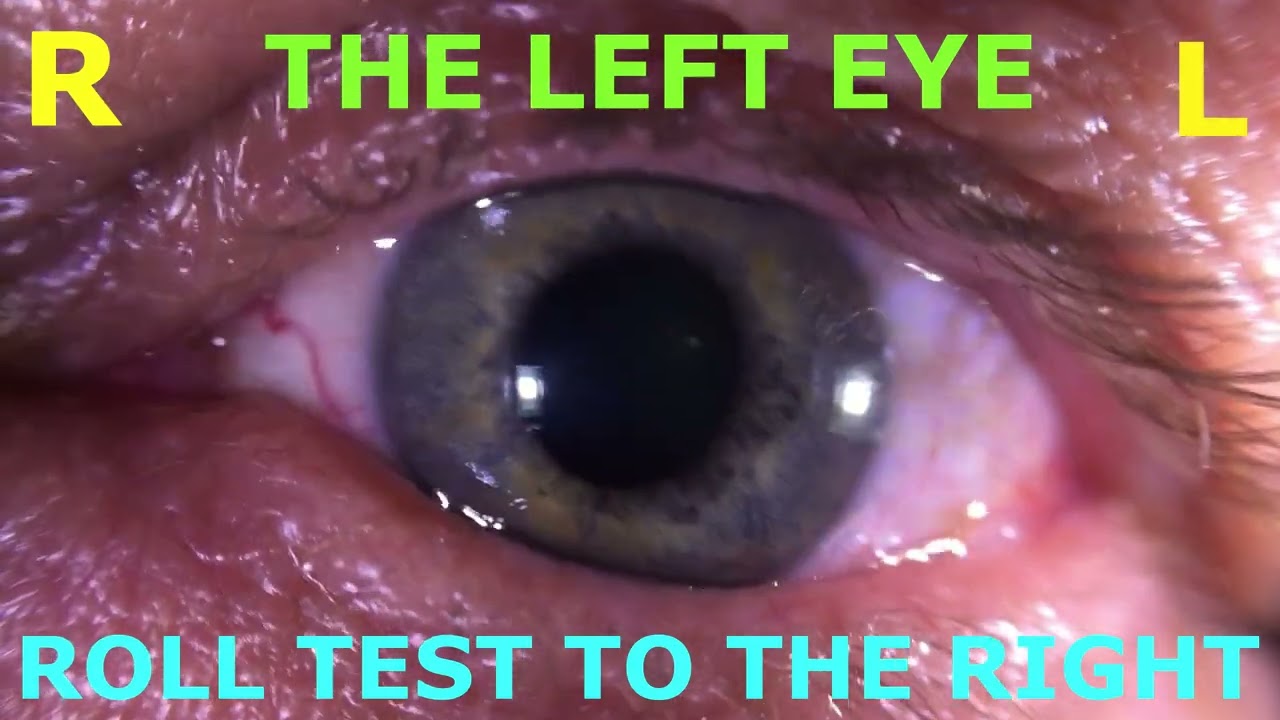 Understanding nystagmus from the left horizontal canal Cupulolithisis| Practical Neuro-otology
