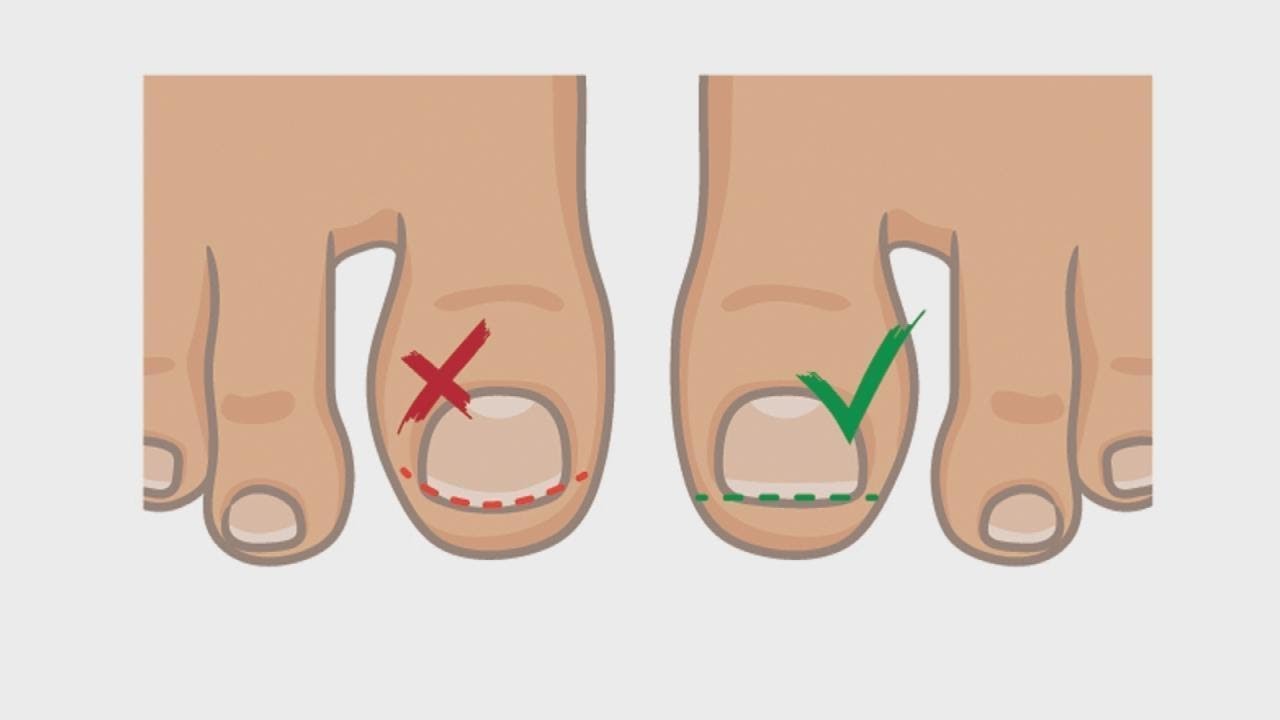 How to Best Handle and Treat an Ingrown Toenail
