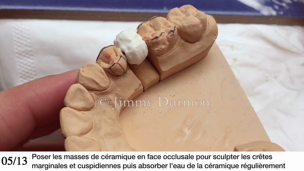 Stratification dentine sur prémolaire : Techniques et astuces pour une esthétique parfaite