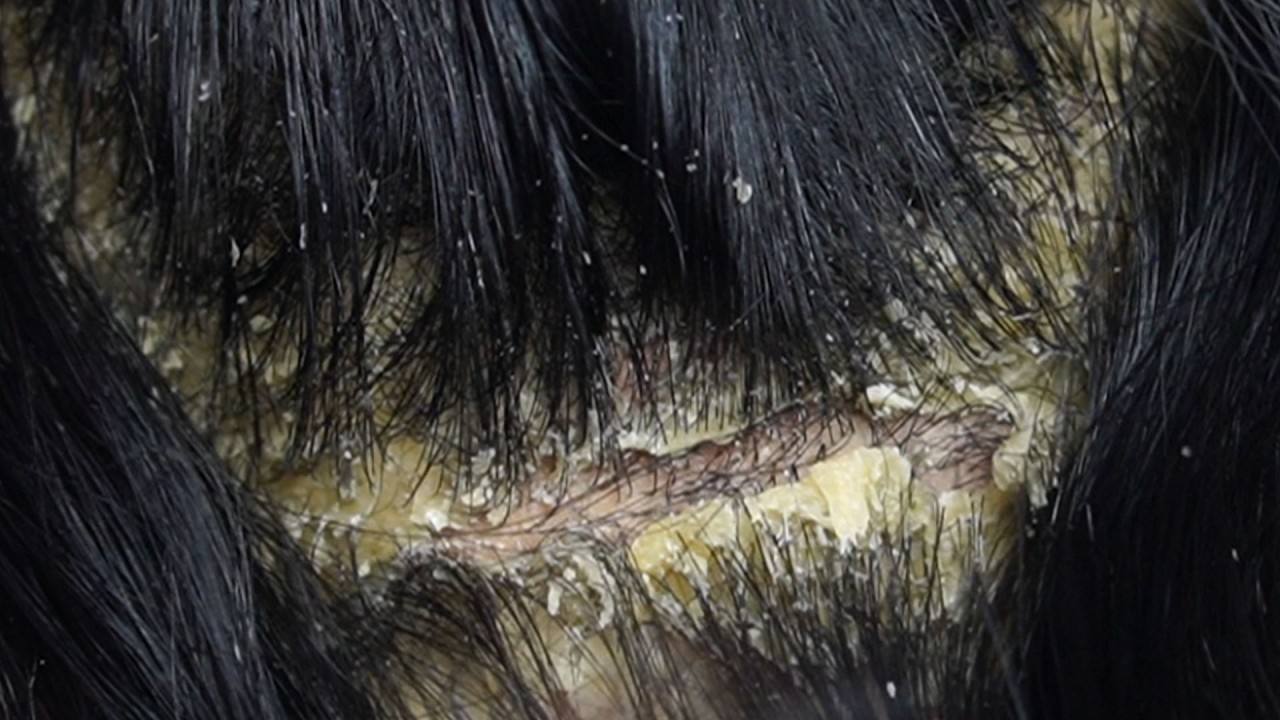 relaxing Treatment and Dandruff Removal Scratching#24