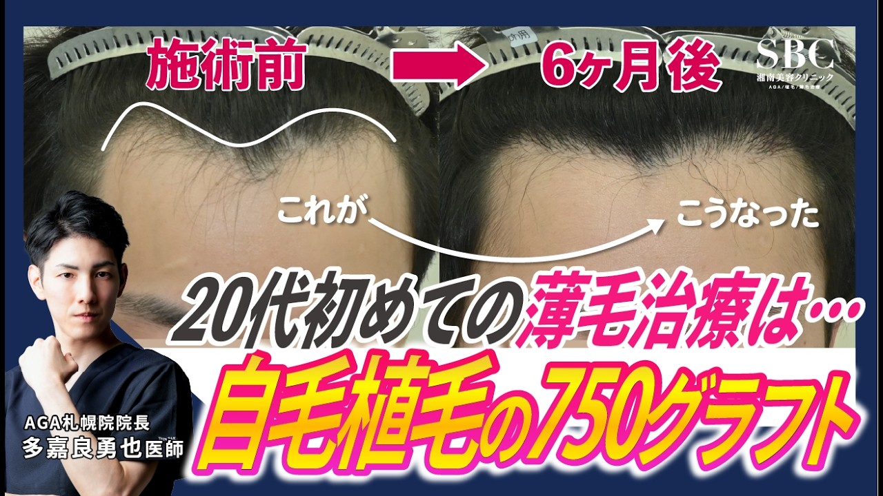 【20代男性の自毛植毛】薄毛治療初心者の自毛植毛。最初の選択肢から自毛植毛。