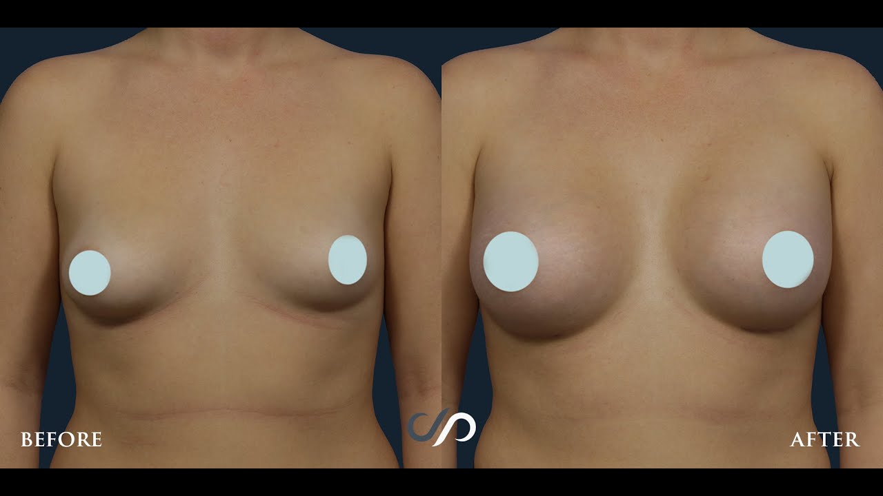L.A. NATURAL BREAST AUGMENTATION SURGERY