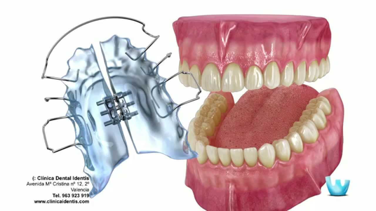 Ortodoncia: Estética o Prevención para la salud bucal?