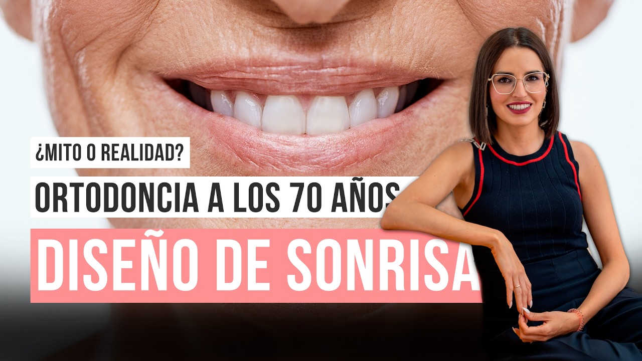 Diseño de sonrisa #acidohialuronico #carillasdentales #blanqueamientodental