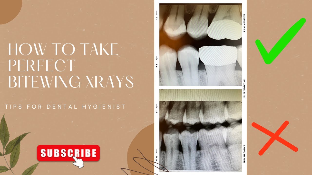 How to take perfect Bitewing X-rays while keeping your patient comfortable