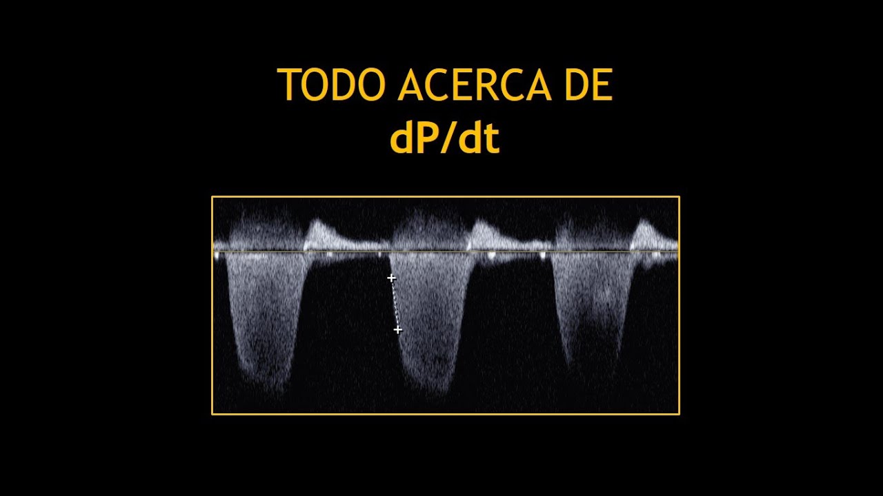 Todo acerca de: DP/DT (Ecocardiografia)!