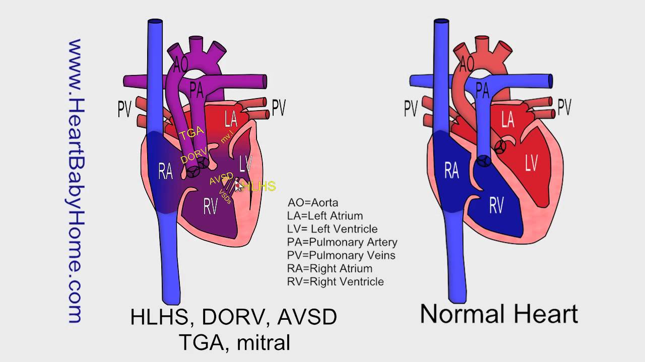 63 - HLHS, DORV, AVSD, tga