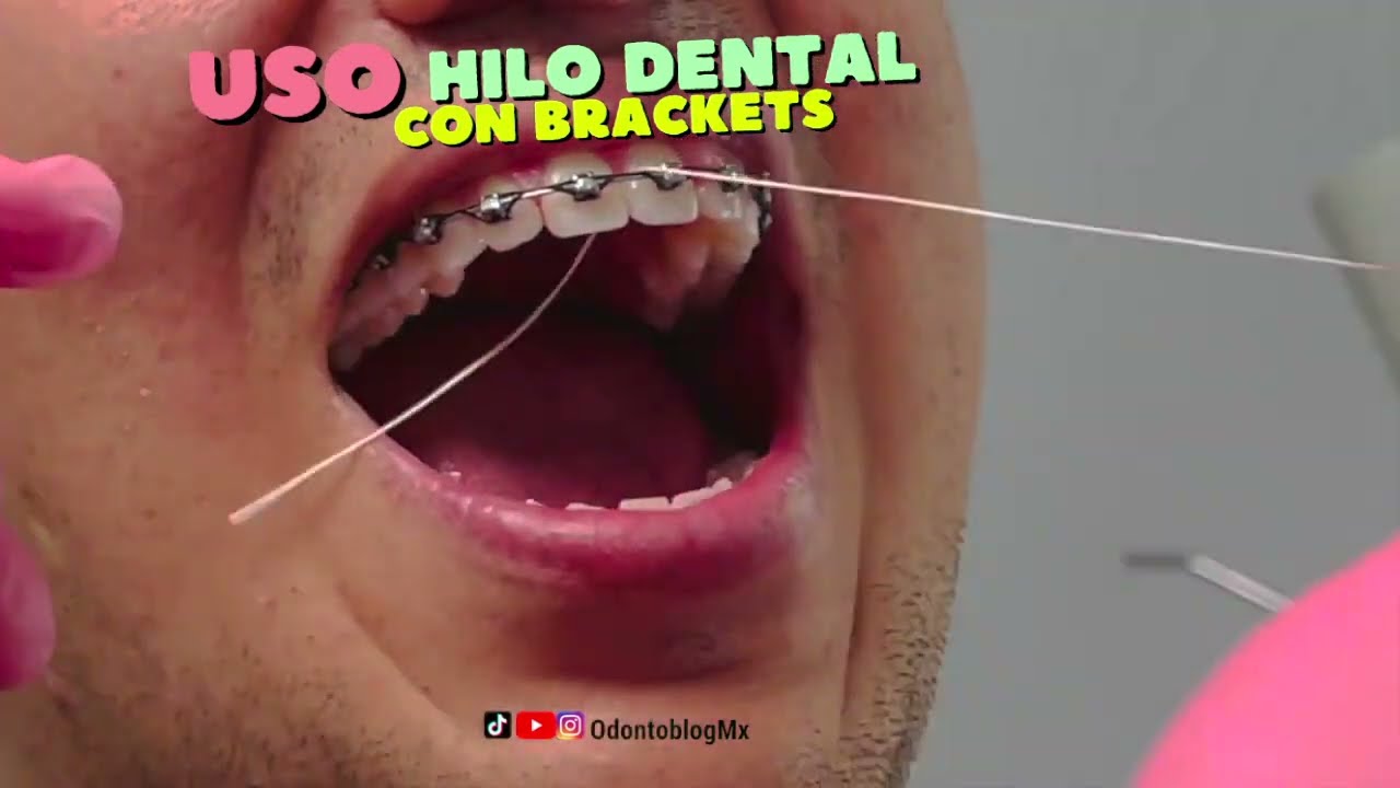 USO DE HILO DENTAL CON BRACKETS