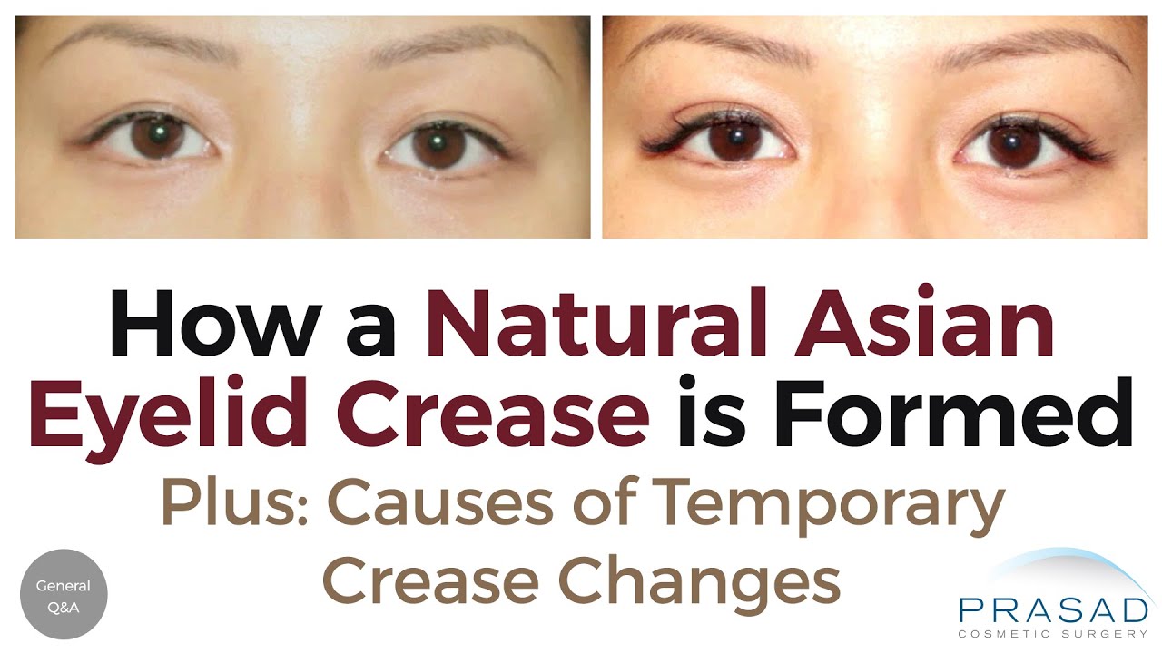 Causes of Natural Asian Double Eyelids Becoming Temporary Monolids, and Making it More Consistent