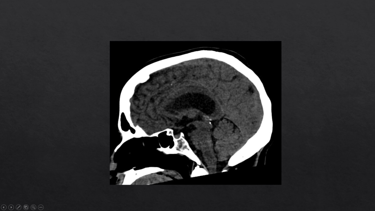 Herniation of the Brain