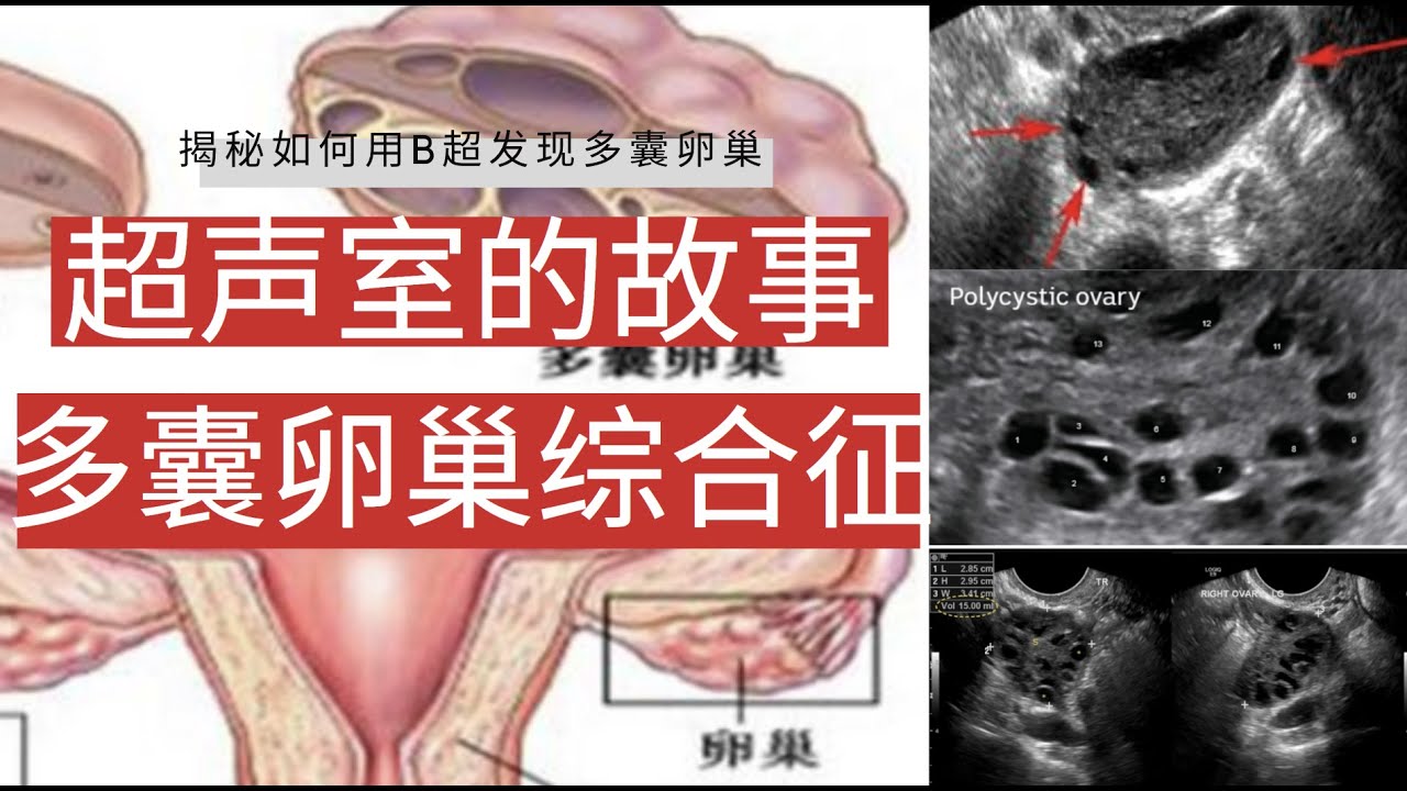 超声室的故事：多囊卵巢综合征【Ultrasound Room】Diagnosing Polycystic Ovarian Syndrome PCOS on Ultrasound