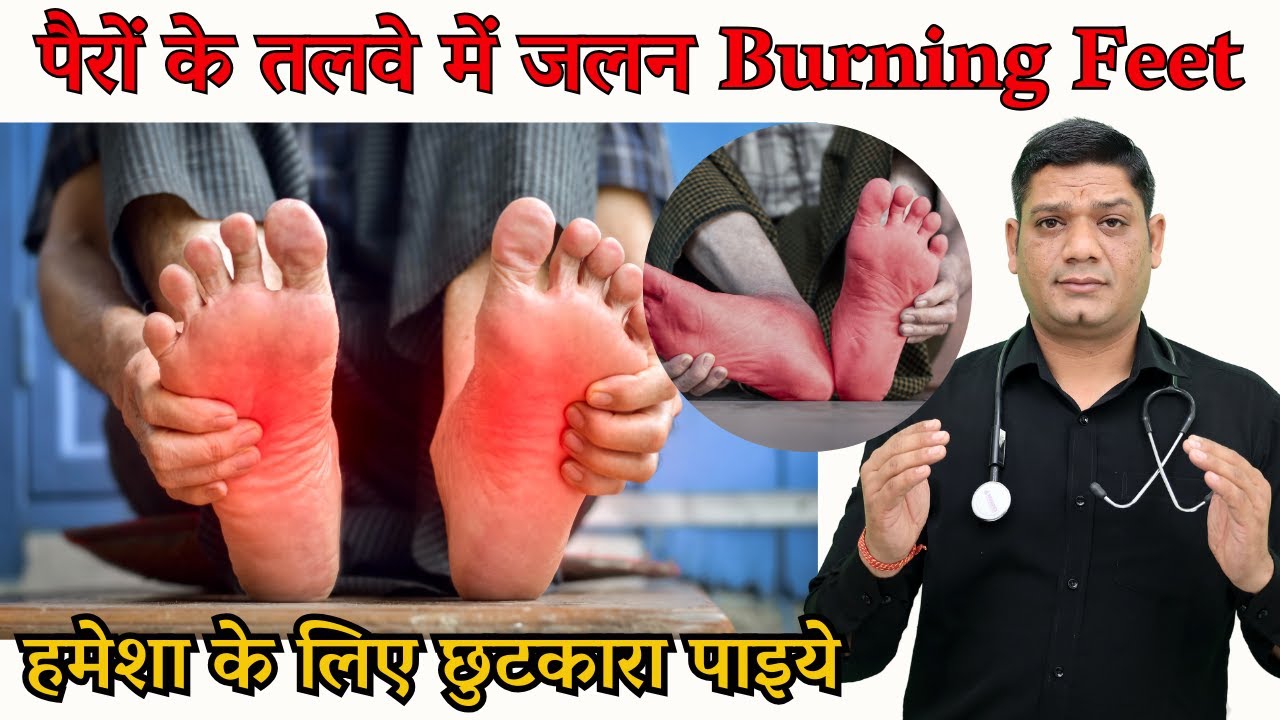 पैरों के तलवे में जलन | Burning Feet Syndrome Homeopathic Treatment Dr. Sunil Patidar 