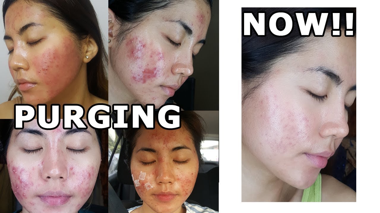 ACNE SKINCARE AND TREATMENT