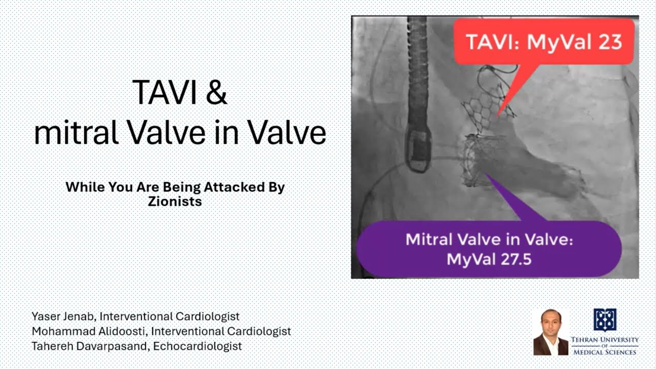 TAVI and mitral Valve In Valve: Balloon Expandable MyVal experience
