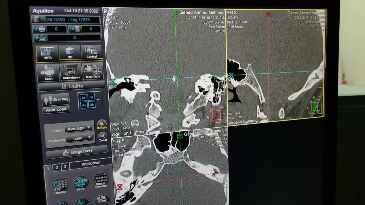 شرح فحص الاشعه المقطعيه علي الاذن وكيفيه تقطيع الصور علي جهاز توشيبا /CT Petrous  Bone