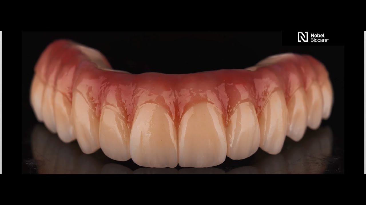 NobelProcera&reg; Esthetic Zirconia Implant Bridge from start to finish | Courtesy of Sean Han