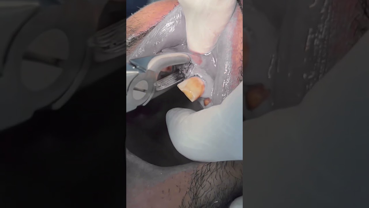 Extraction of remaining root #dentist