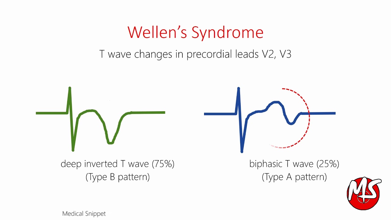 Wellens Syndrome with ECG and Angiography example