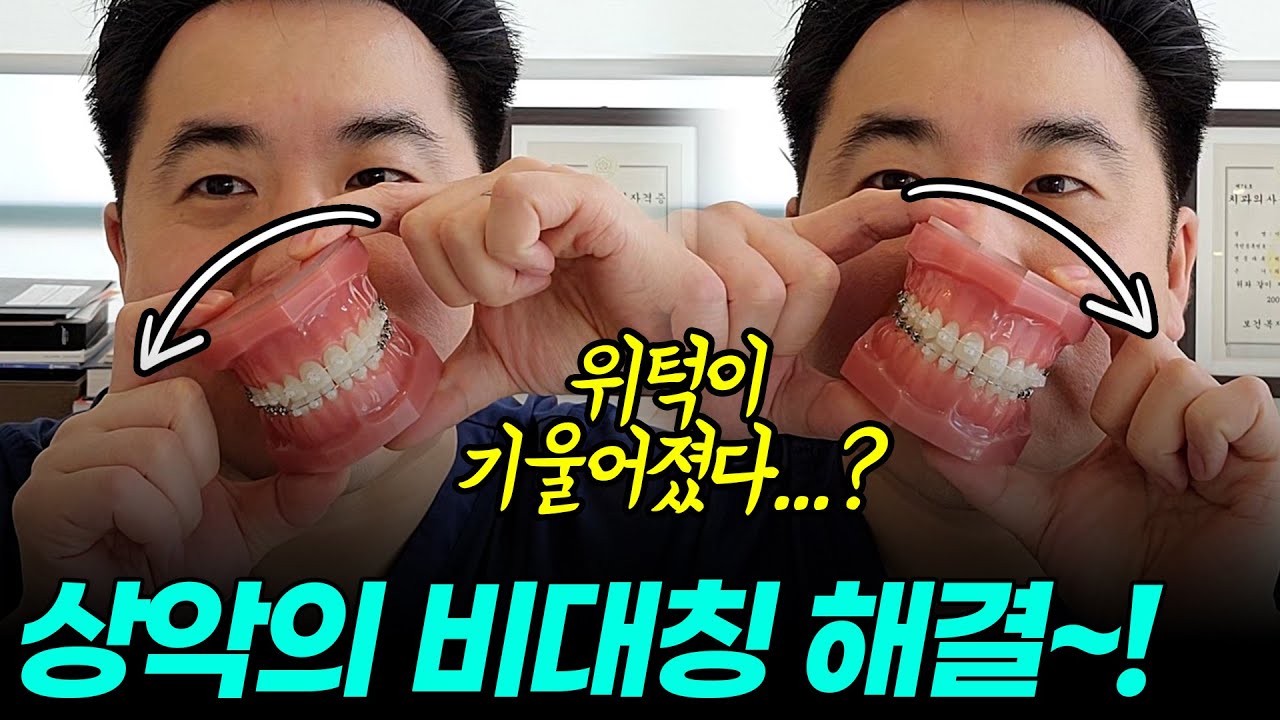 상악의 비대칭 원인과 해결 방법은...?