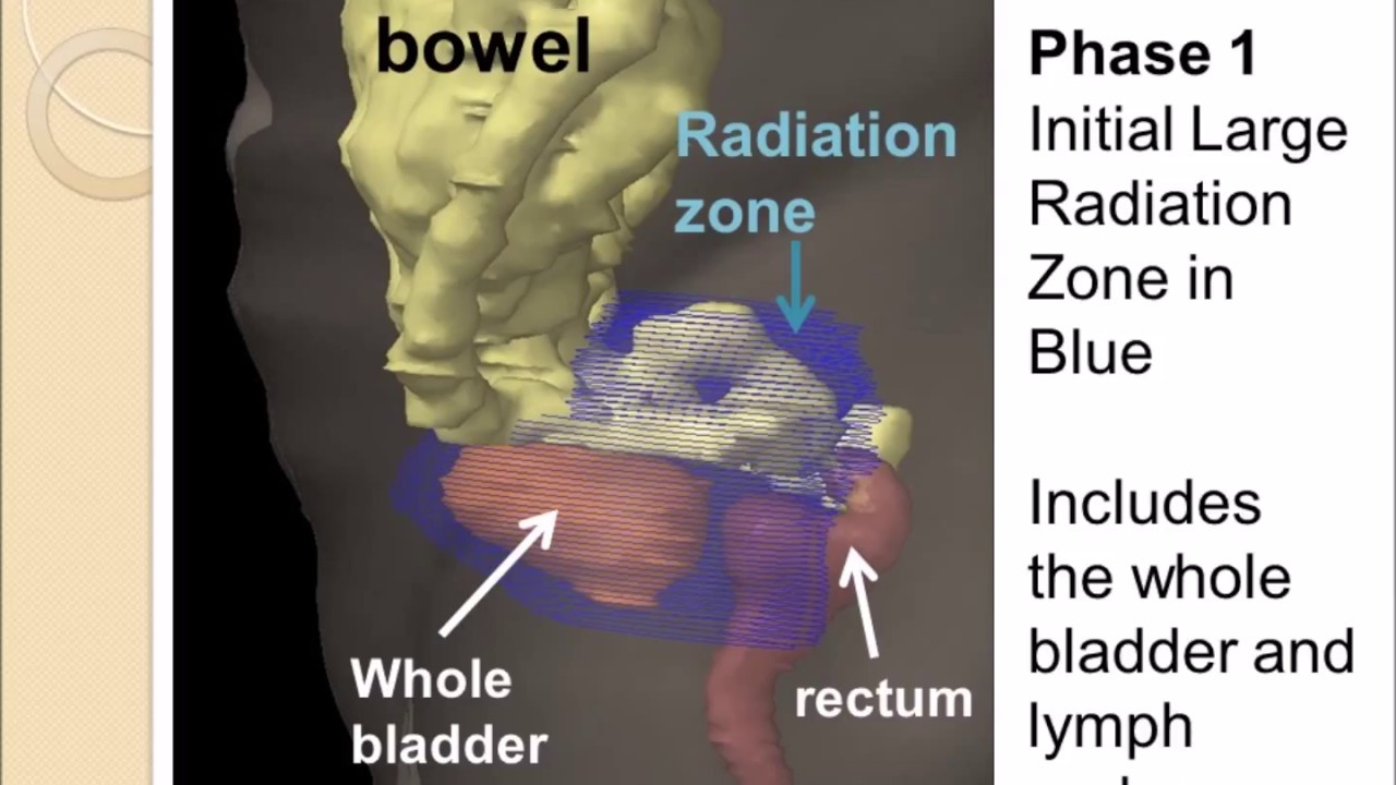 Radiation Therapy for Bladder Cancer