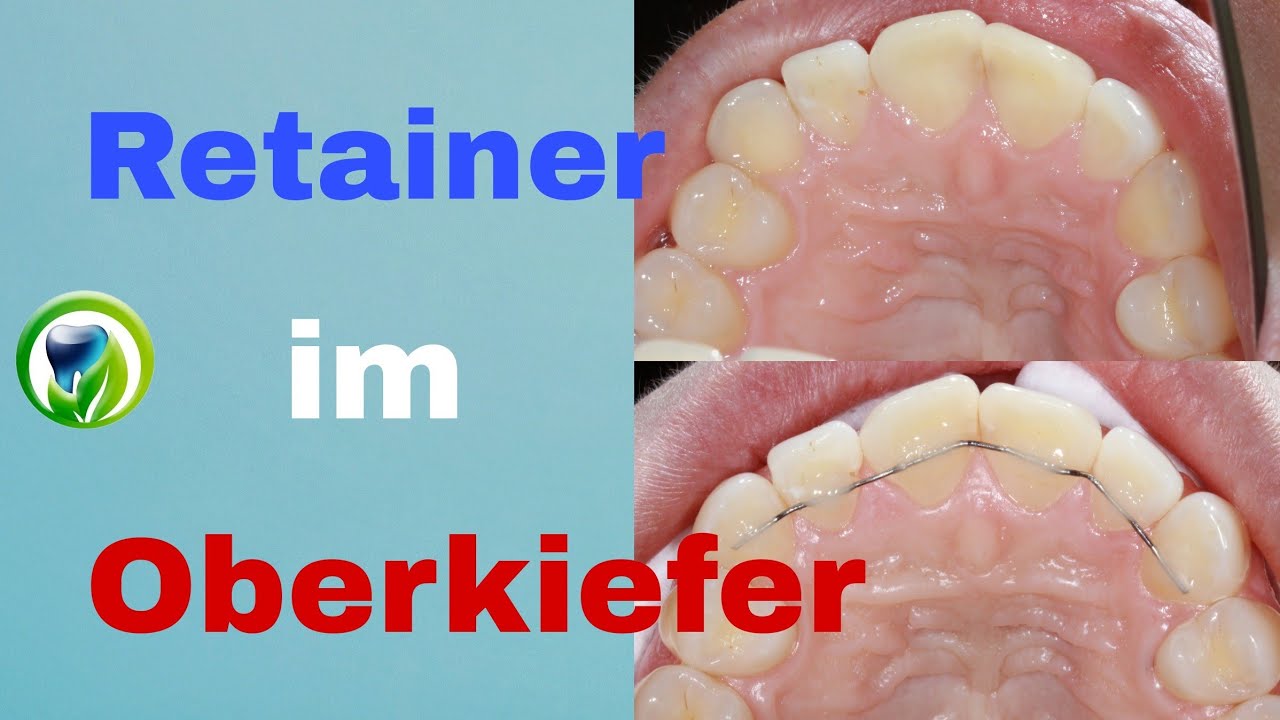 Patientenfall mit einem Retainer | Zähne nach KFO - herausnehmbare Zahnspange
