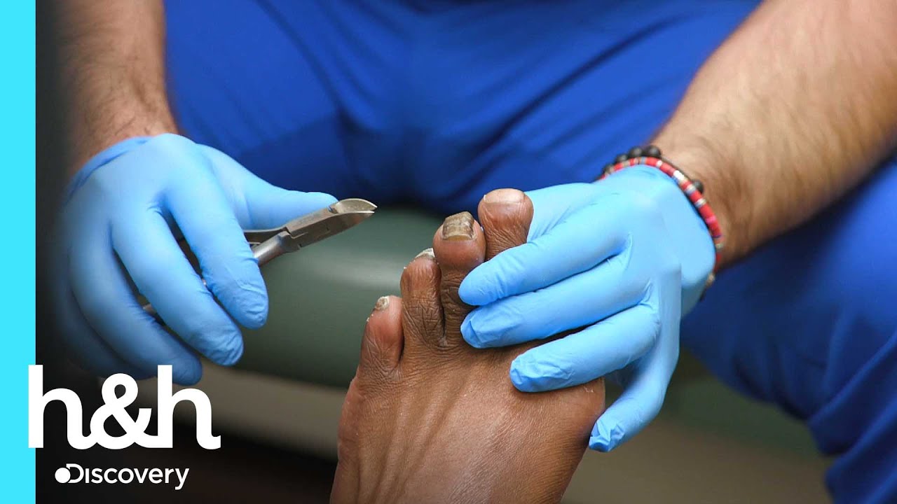 Mujer obliga a su novio a ocultar sus pies por hongos | Especialistas en pies | Discovery H&H