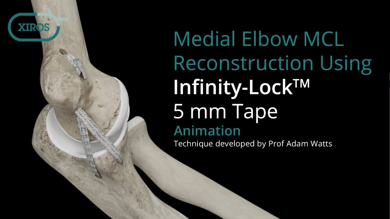 Medial Elbow MCL Reconstruction using Infinity-Lock™ Tape - Surgical Animation