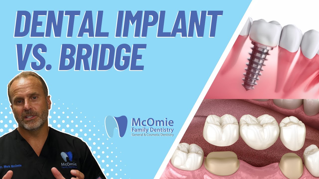 Dental Implants Vs. Bridges - Which One Is Best For You? | Dr. Mark McOmie Explains