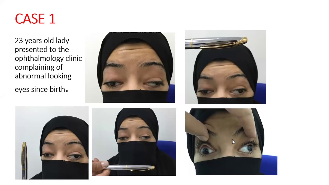 pediatric ophthalmology CTR , Dr.Amal Alhemidan