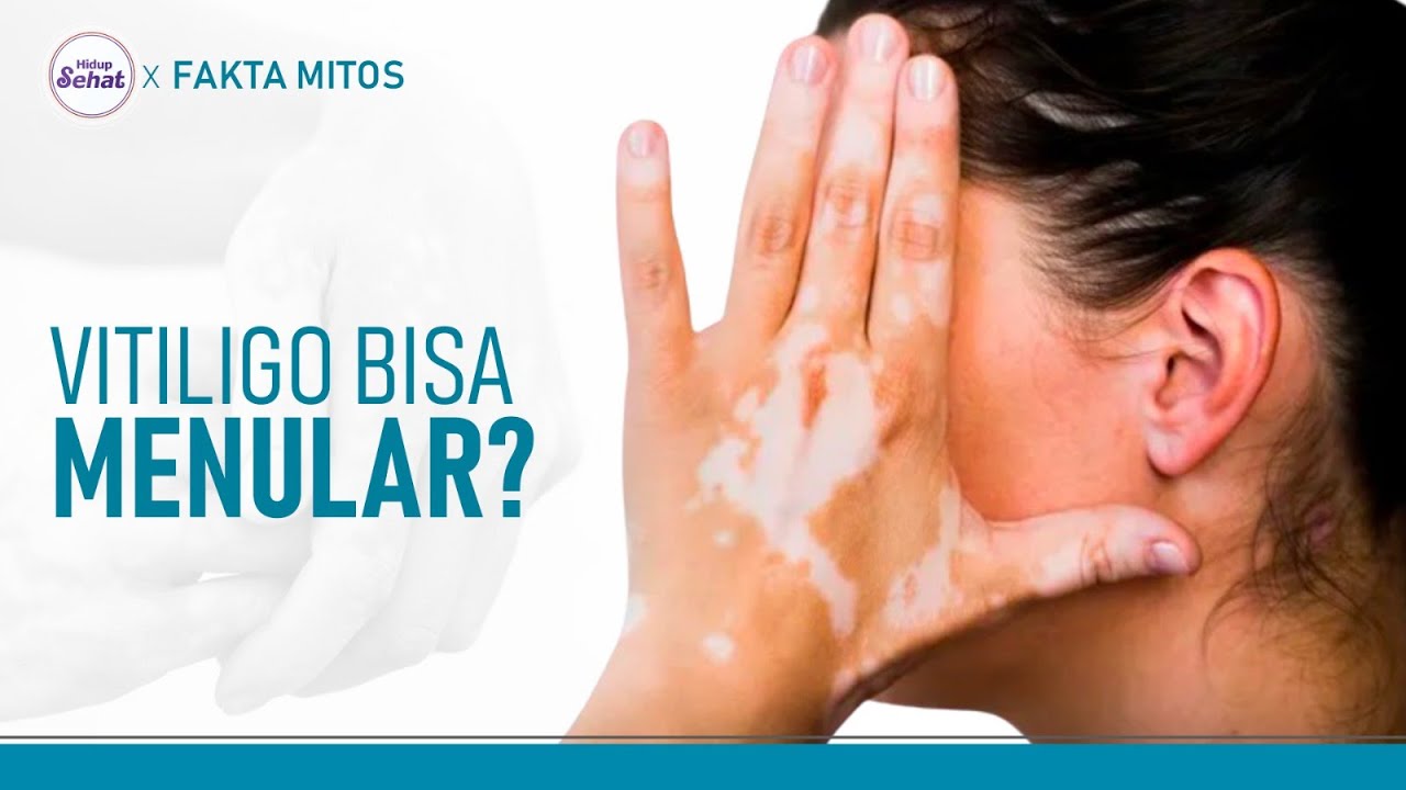 Seberapa Bahaya Vitiligo, Apakah Menular? | Hidup Sehat tvOne
