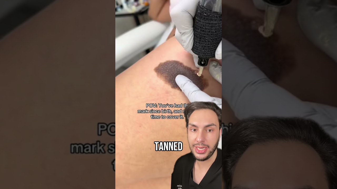 BEST treatments for birthmark removal