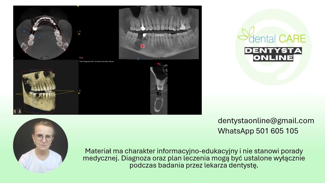 Analizujemy Wasze zdjęcia! Cz. 3- złamany ząb, torbiel, estetyka #kalisz #dentalcare #stomatolog