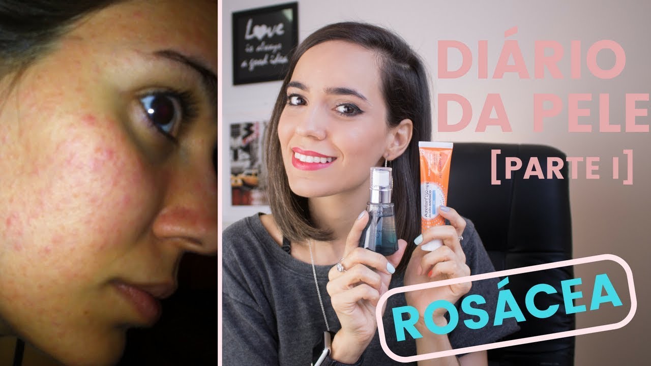 Rosácea - Saiba Como Vencer! [Diário da Pele - Parte I] | Iruama
