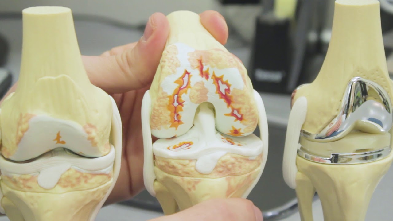 Opis operacije/ugradnje umjetnog koljena na modelu