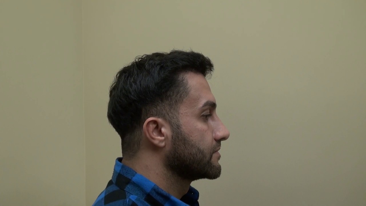 FUE Hair Transplant Doctor San Francisco San Jose California Surgery Bald Hair Loss Treatment