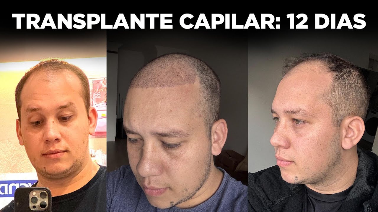 COMO FOI MEU TRANSPLANTE CAPILAR NA STANLEY'S HAIR? 12 DIAS DEPOIS