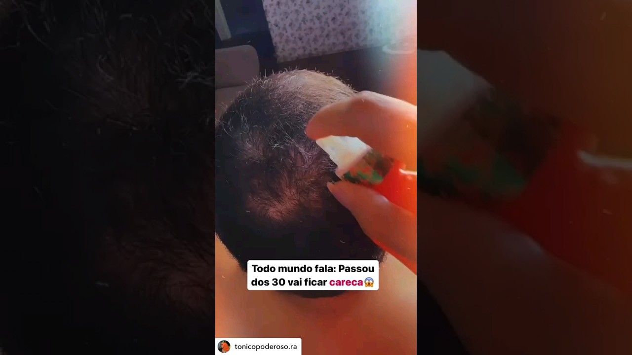 tonico poderoso funciona em HOMEM? #crescimentocapilar #calvo