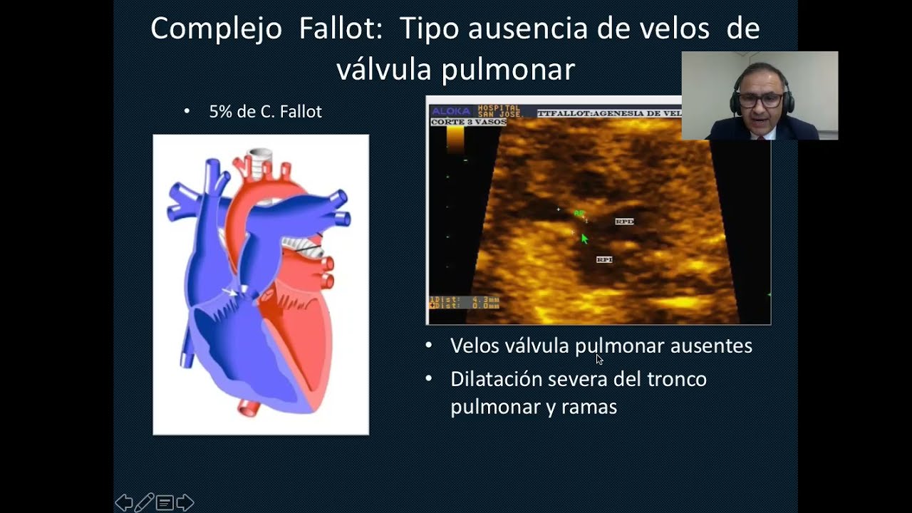 TETRALOGIA DE  FALLOT  DR. IGNACIO MONTAÑO